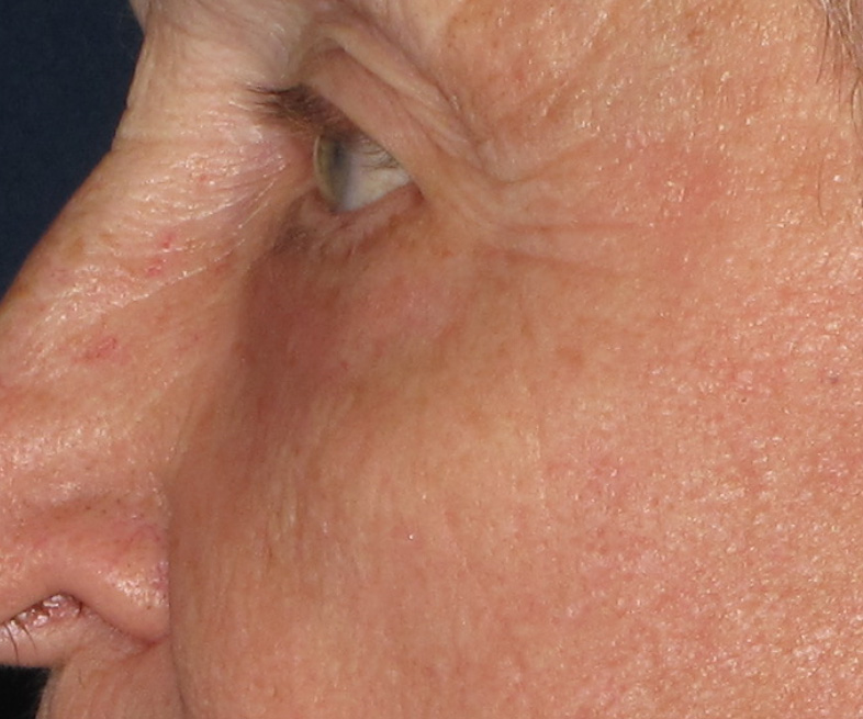 micro-laser-peel-5_after - Elizabeth Roche