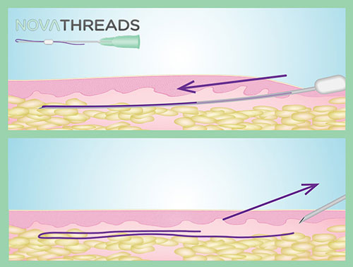 Body Operation Thread NovaThreads, PDO Thread Lift, Bergen County NJ