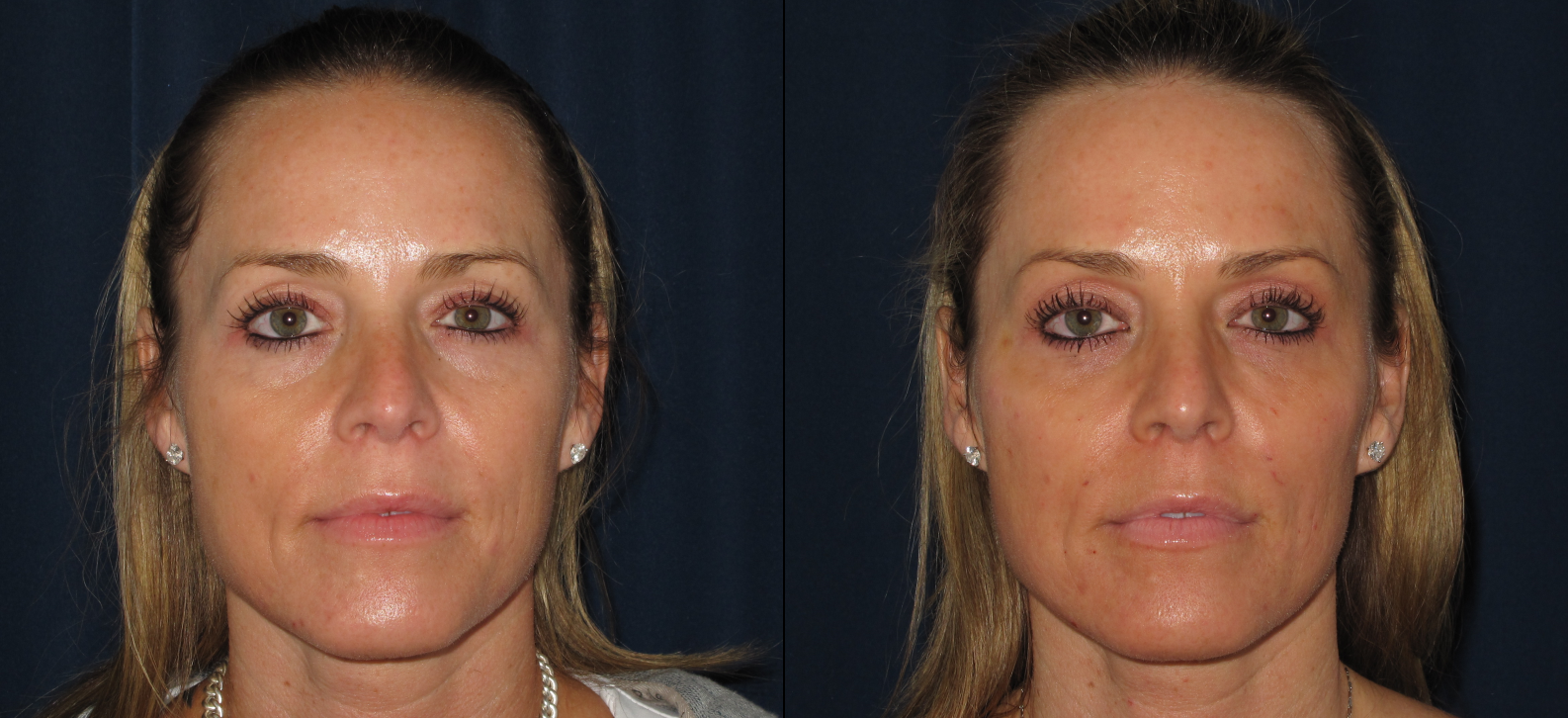 dermal-fillers-cheeks-cropped