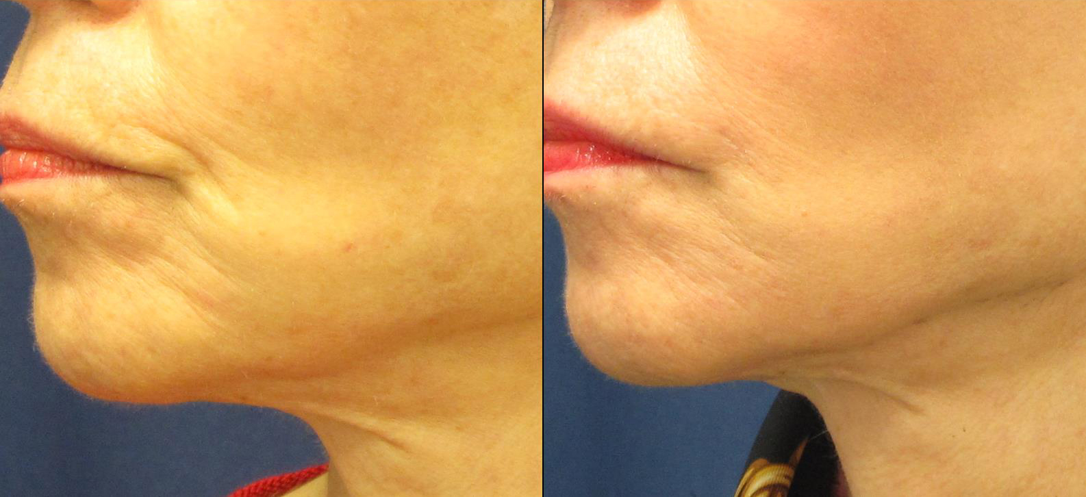 dermal-fillers-marionette-lines-cropped