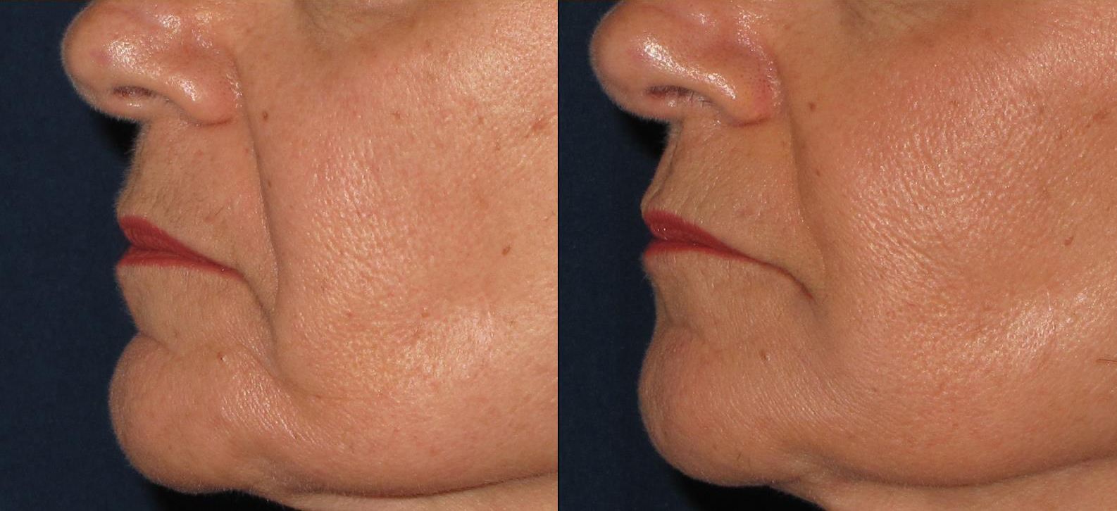 dermal-fillers-nasal-labial-folds-cropped