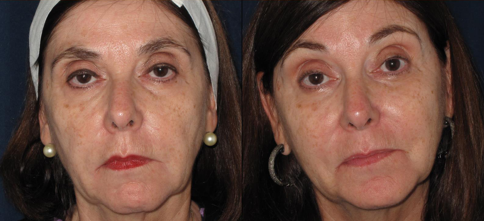 dermal-fillers-under-eyes-and-cheeks-2-cropped