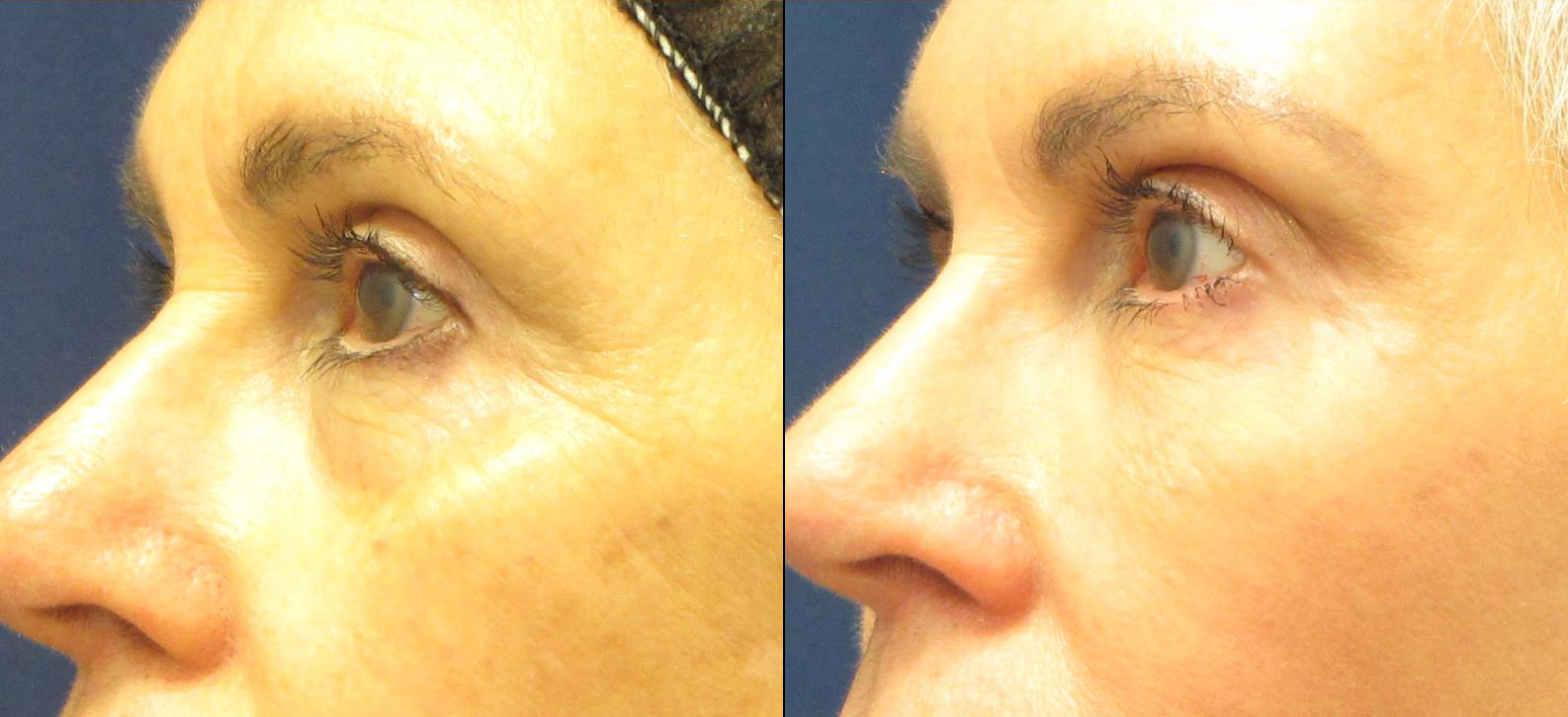 dermal-fillers-under-eyes-and-cheeks-cropped