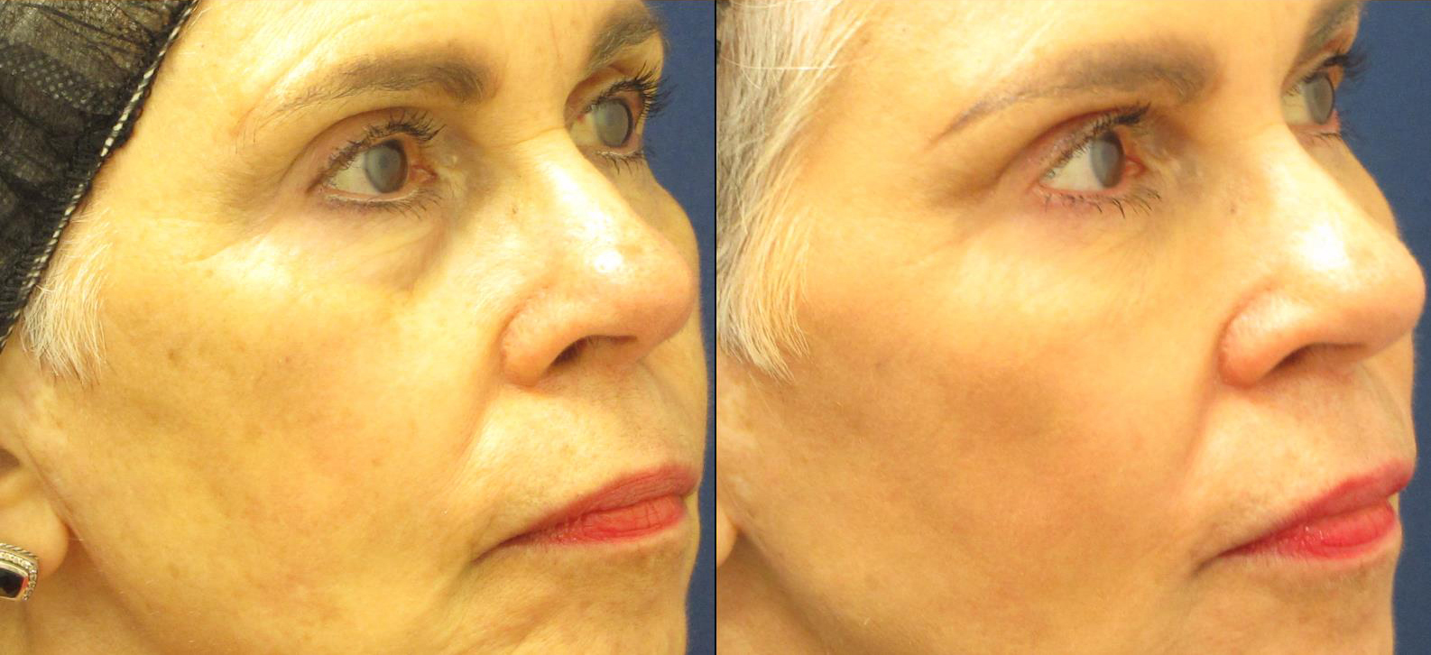 dermal-fillers-under-eyes_cheeks_nasal-labial-folds-cropped