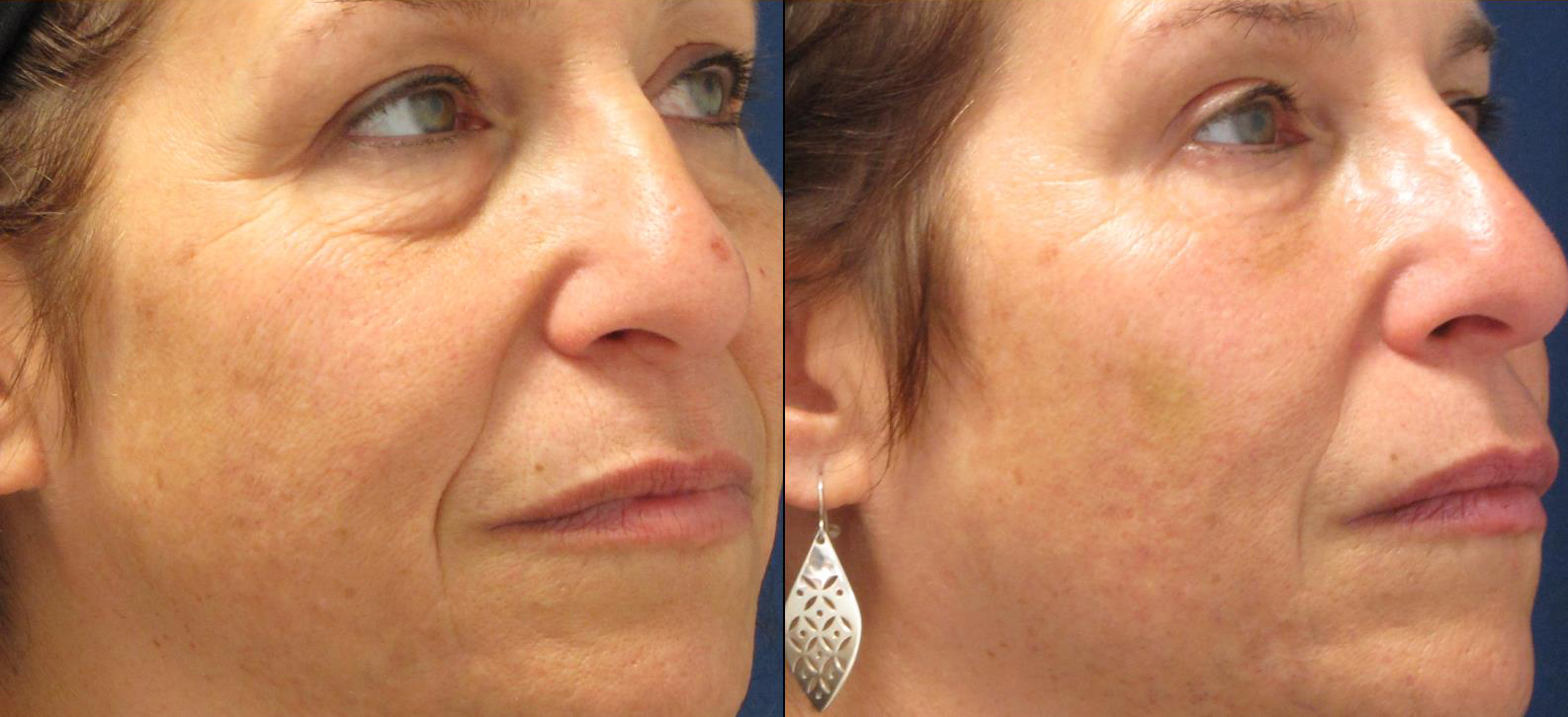 dermal-fillers-under-eyes_nasal-labial-folds_marionette-lines-2-cropped