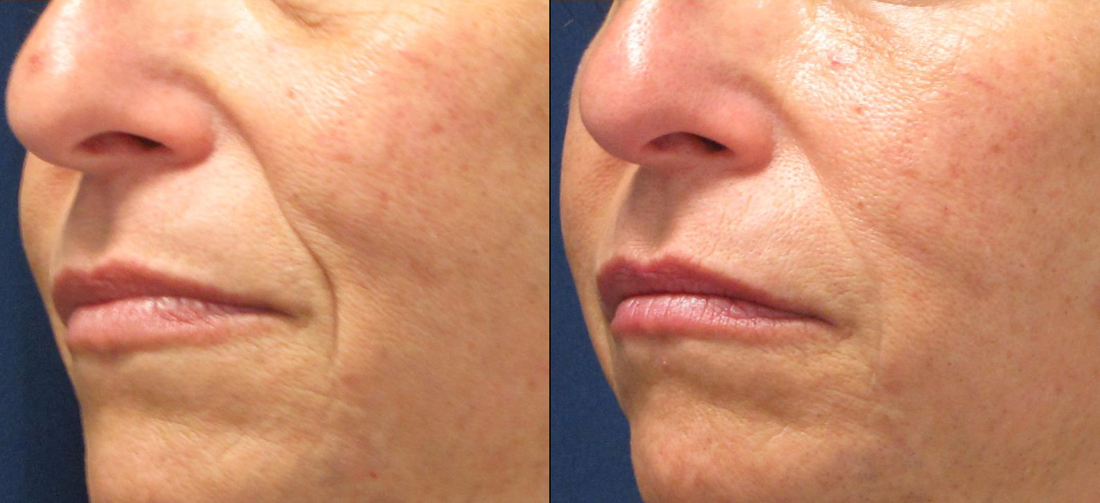 dermal-fillers-under-eyes_nasal-labial-folds_marionette-lines-cropped
