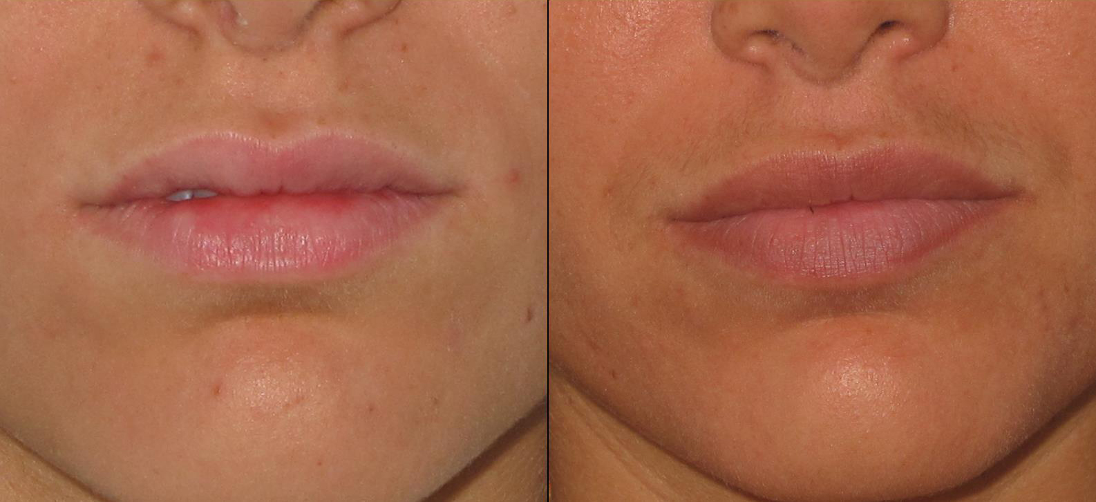 lips1