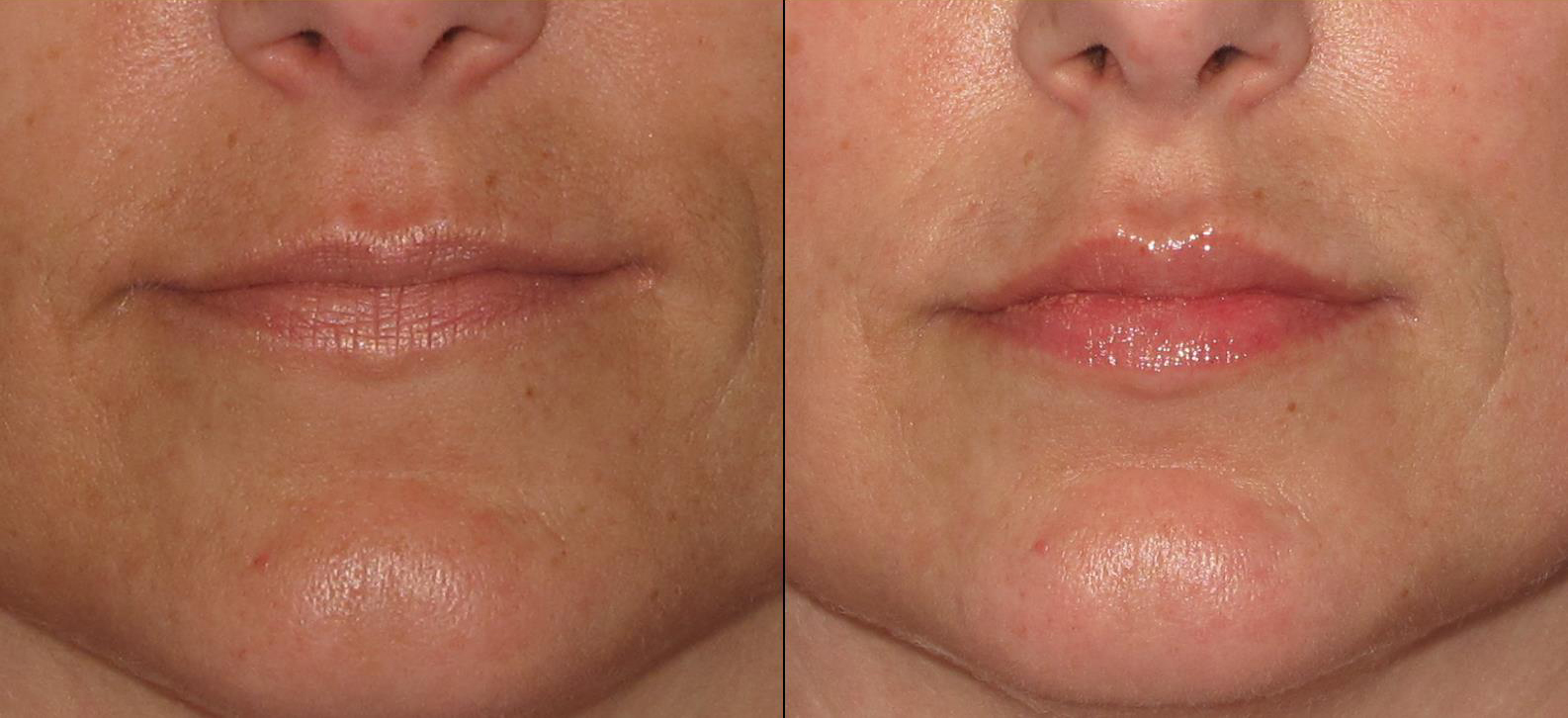 lips2