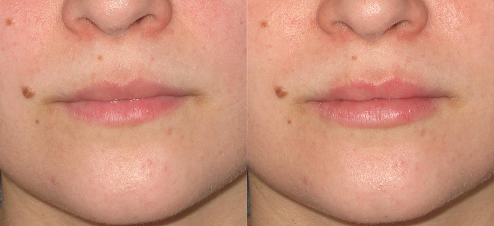 lips5