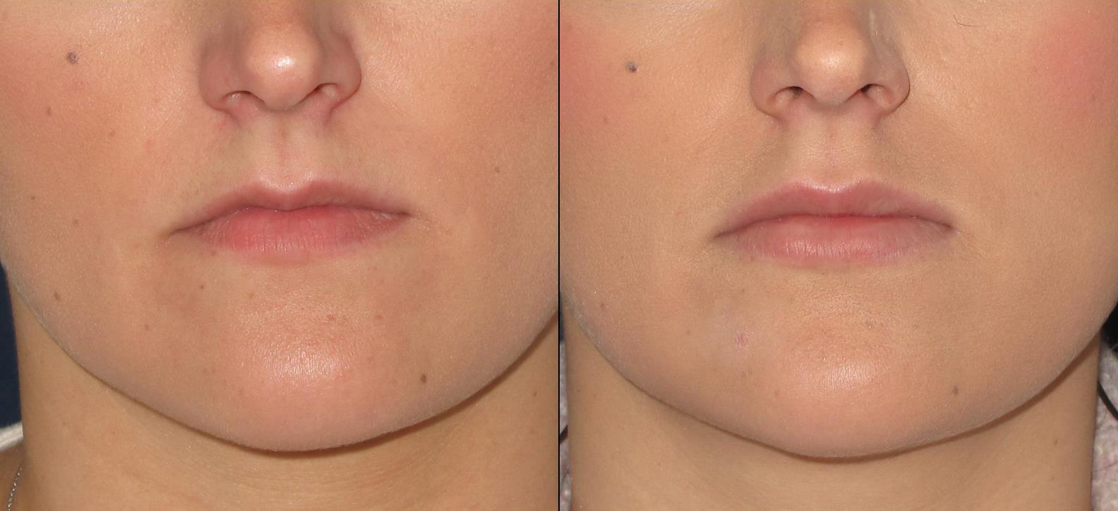 lips6
