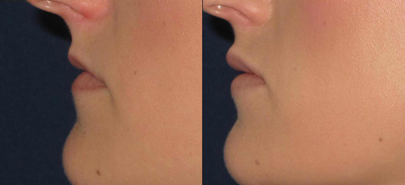 lips7