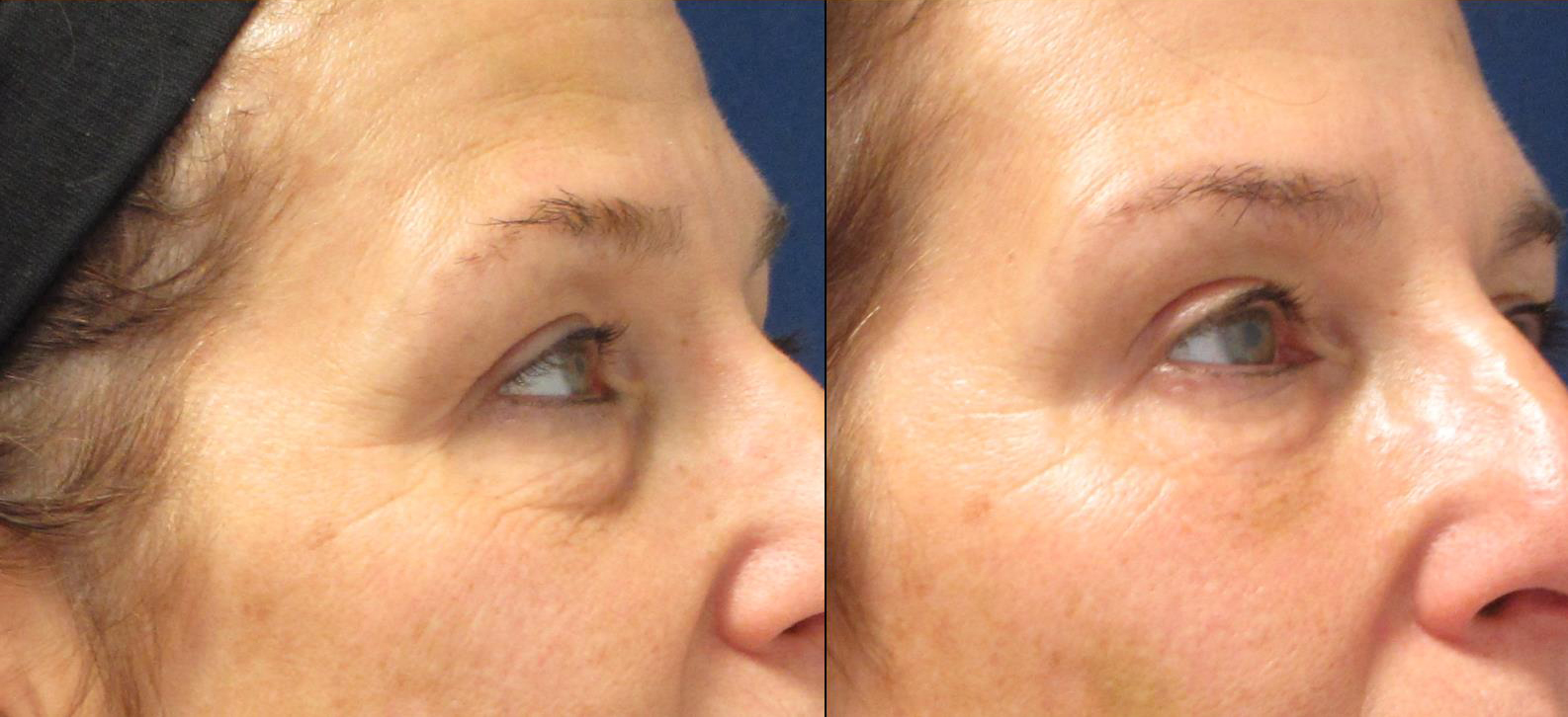 undereyes2