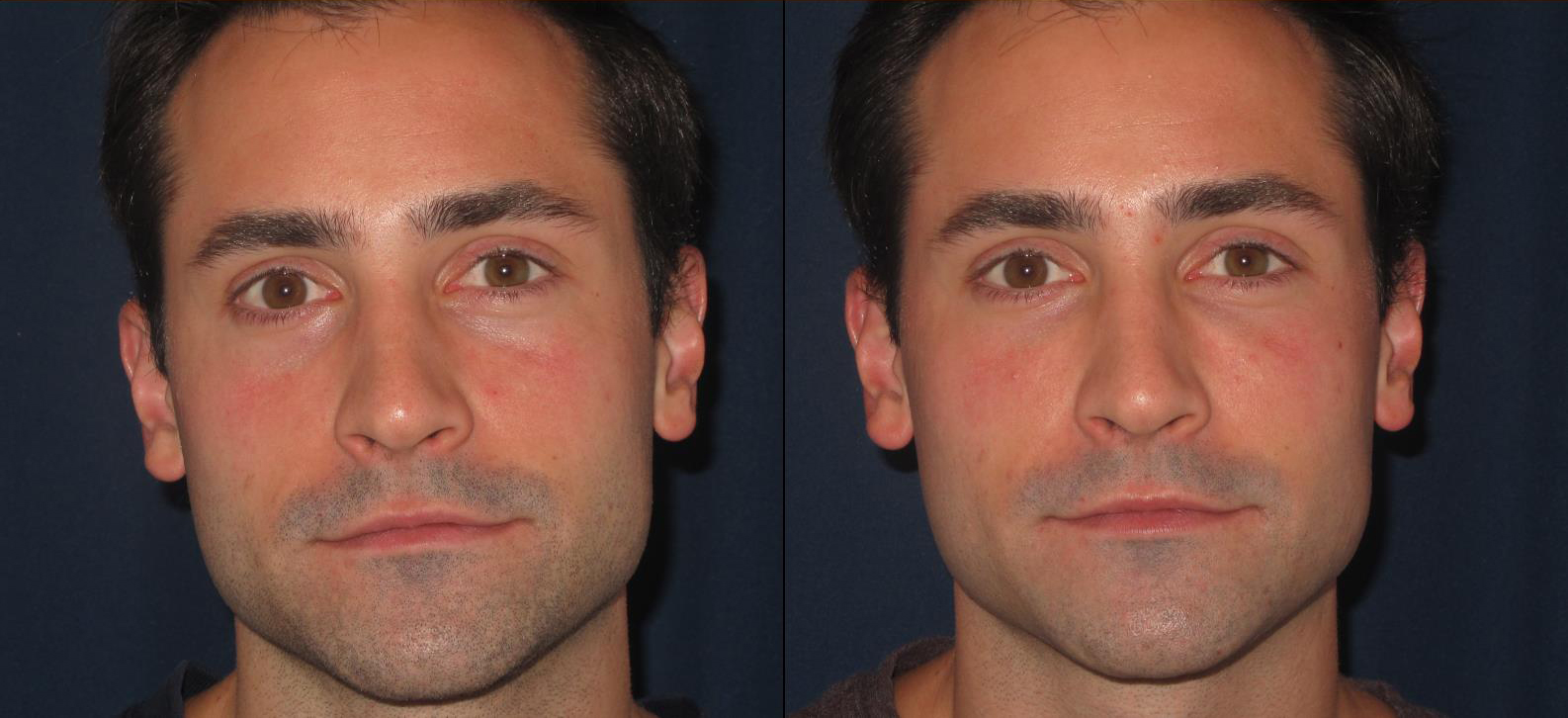 undereyes3