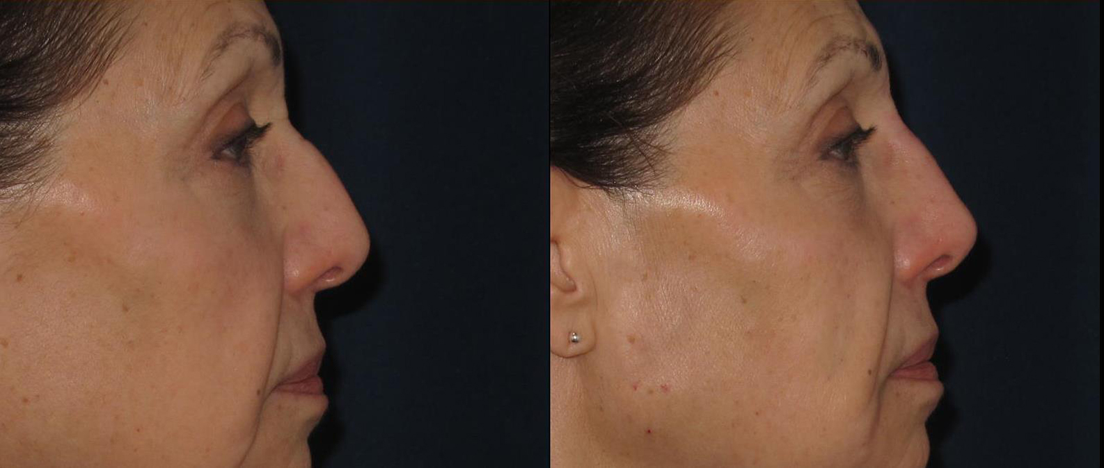 dermal-fillers-nose-5