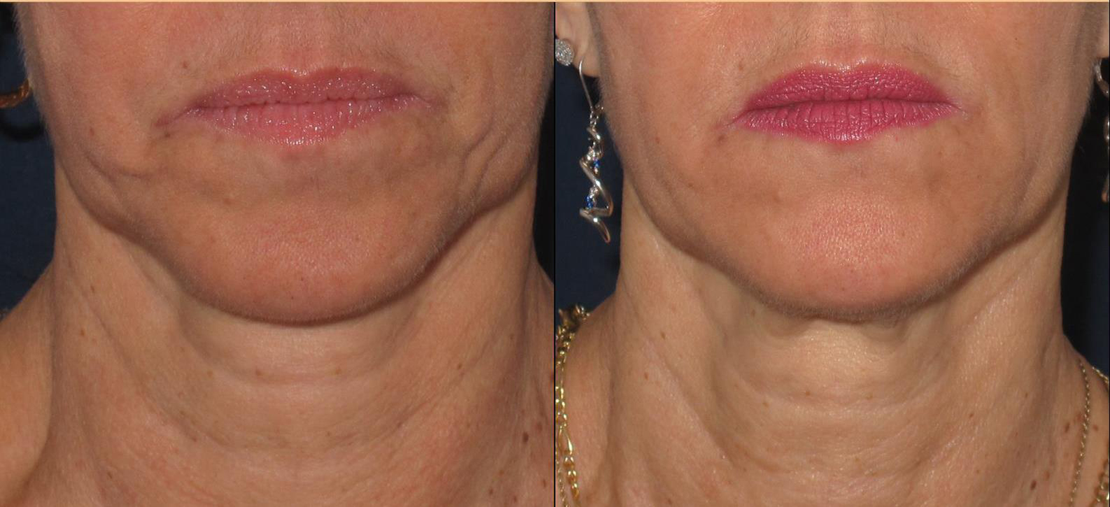 ultherapy-dermal-fillers-6