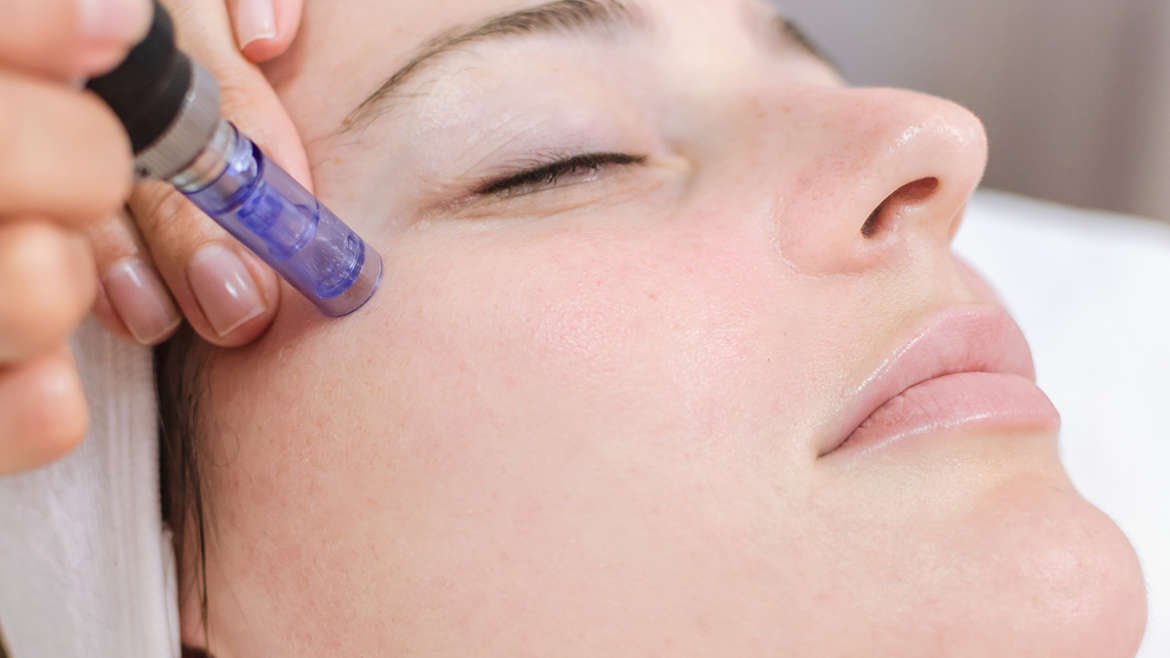 What Your Esthetician Wants You to Know About Microneedling