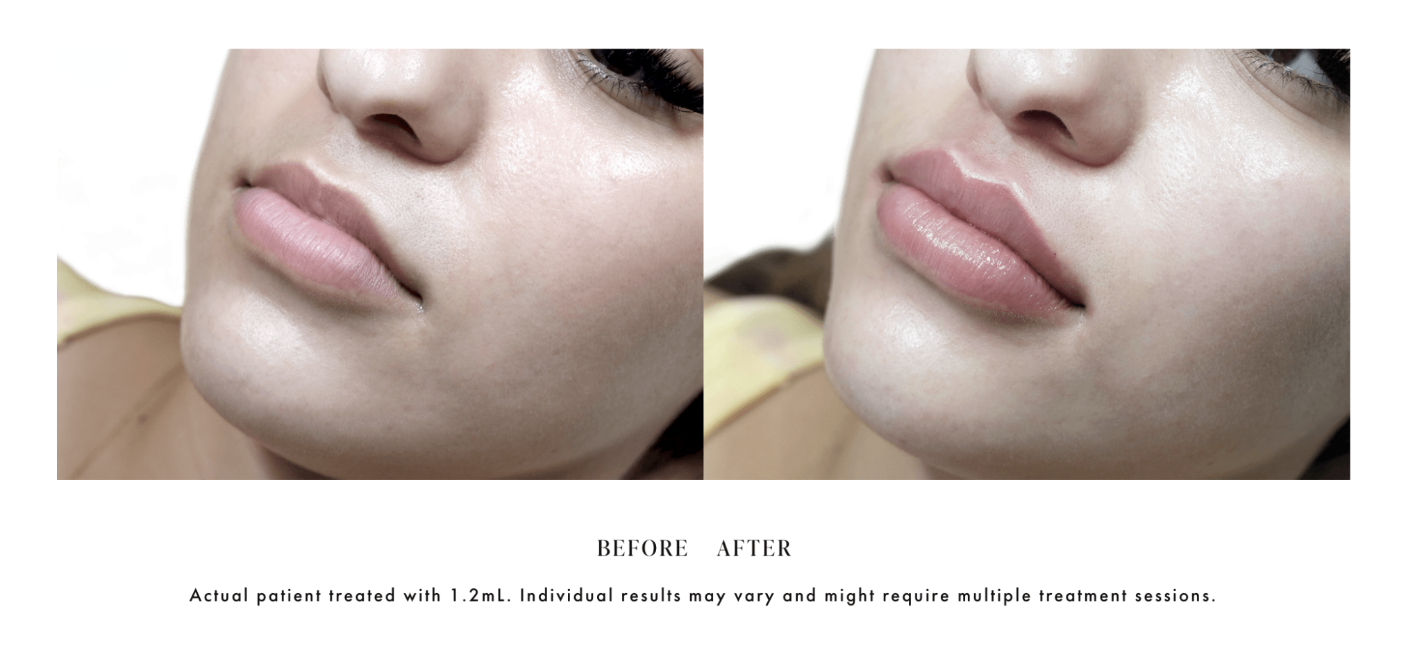 Revanesse Lips+ Lip Filler Elizabeth Roche, MD