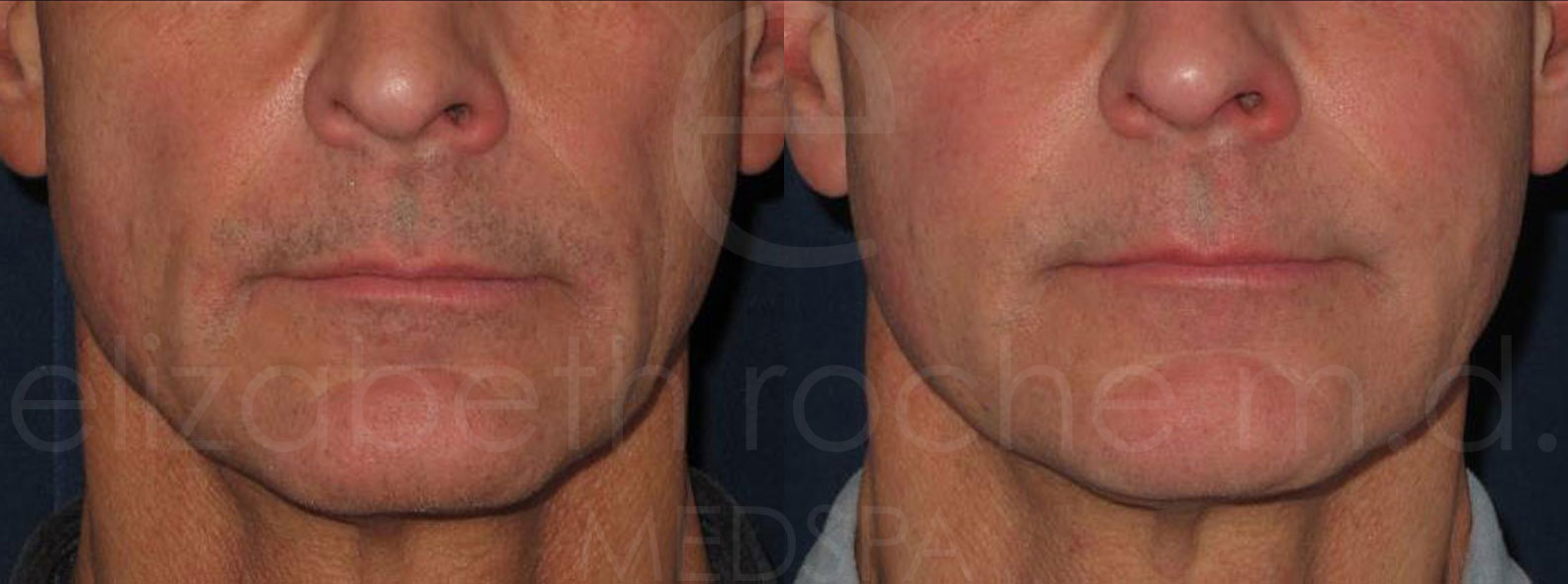 dermal-fillers-full-face_neurotoxin-forehead-glabella-and-eye-area-cropped-1-1-wm