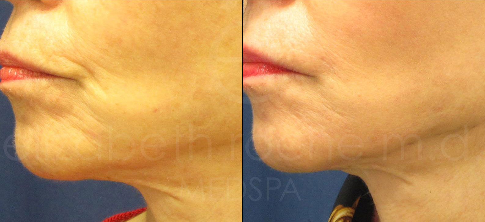 dermal-fillers-marionette-lines-cropped-wm