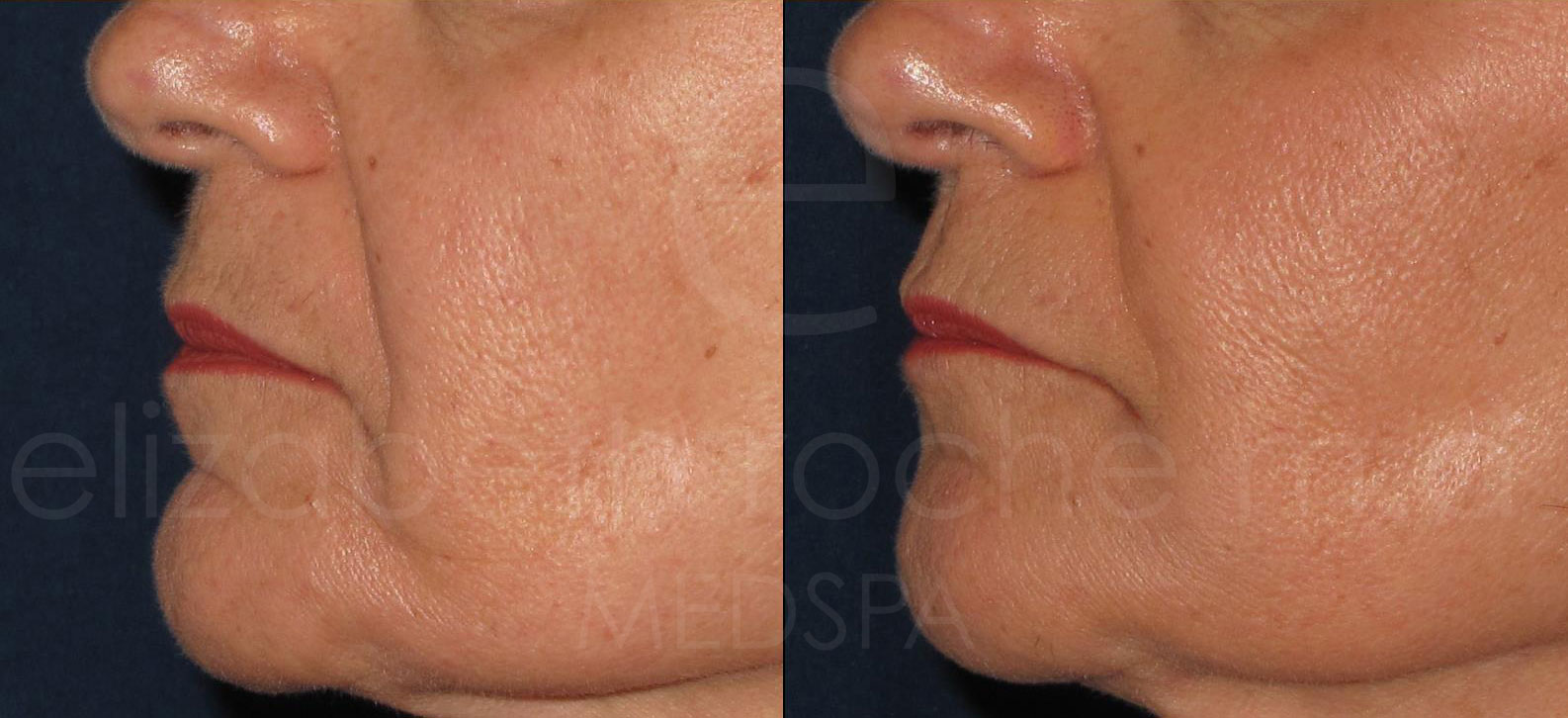 dermal-fillers-nasal-labial-folds-cropped-wm