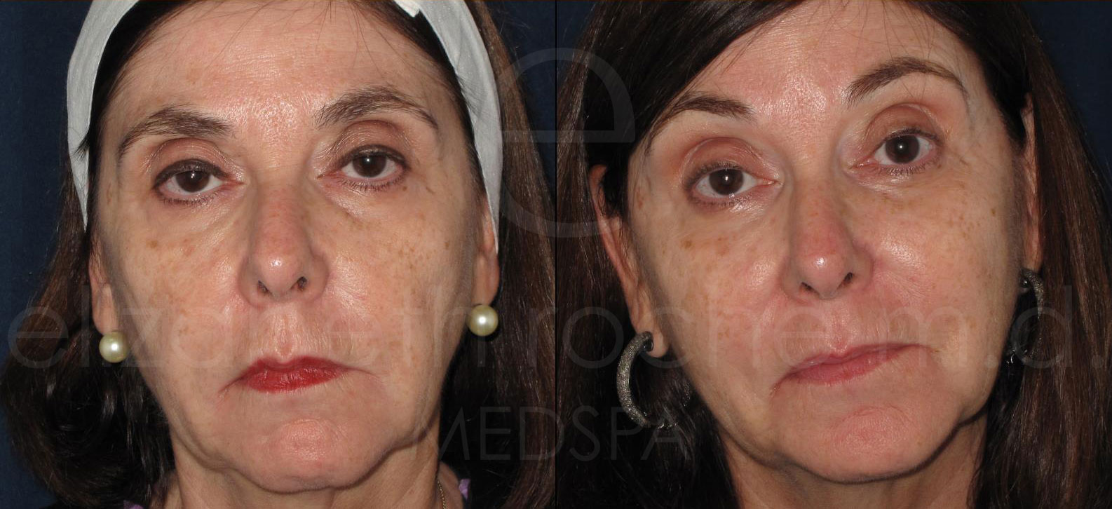 dermal-fillers-under-eyes-and-cheeks-2-cropped-wm