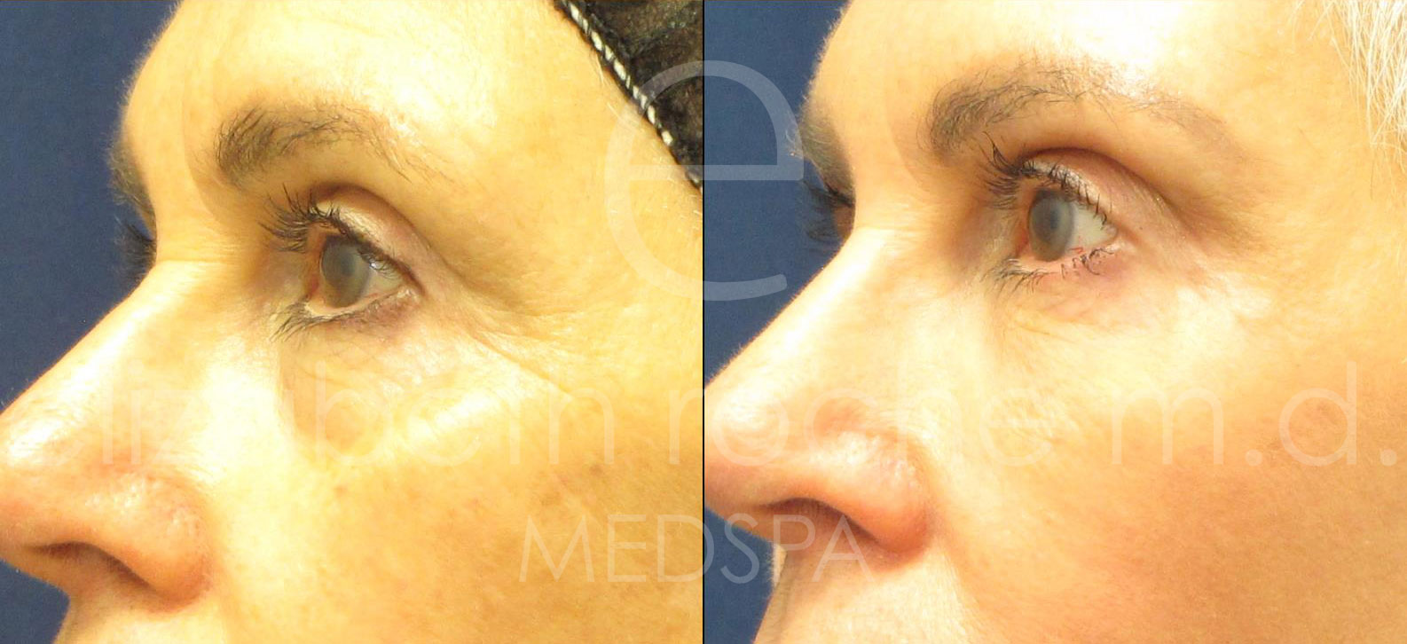 dermal-fillers-under-eyes-and-cheeks-cropped-wm