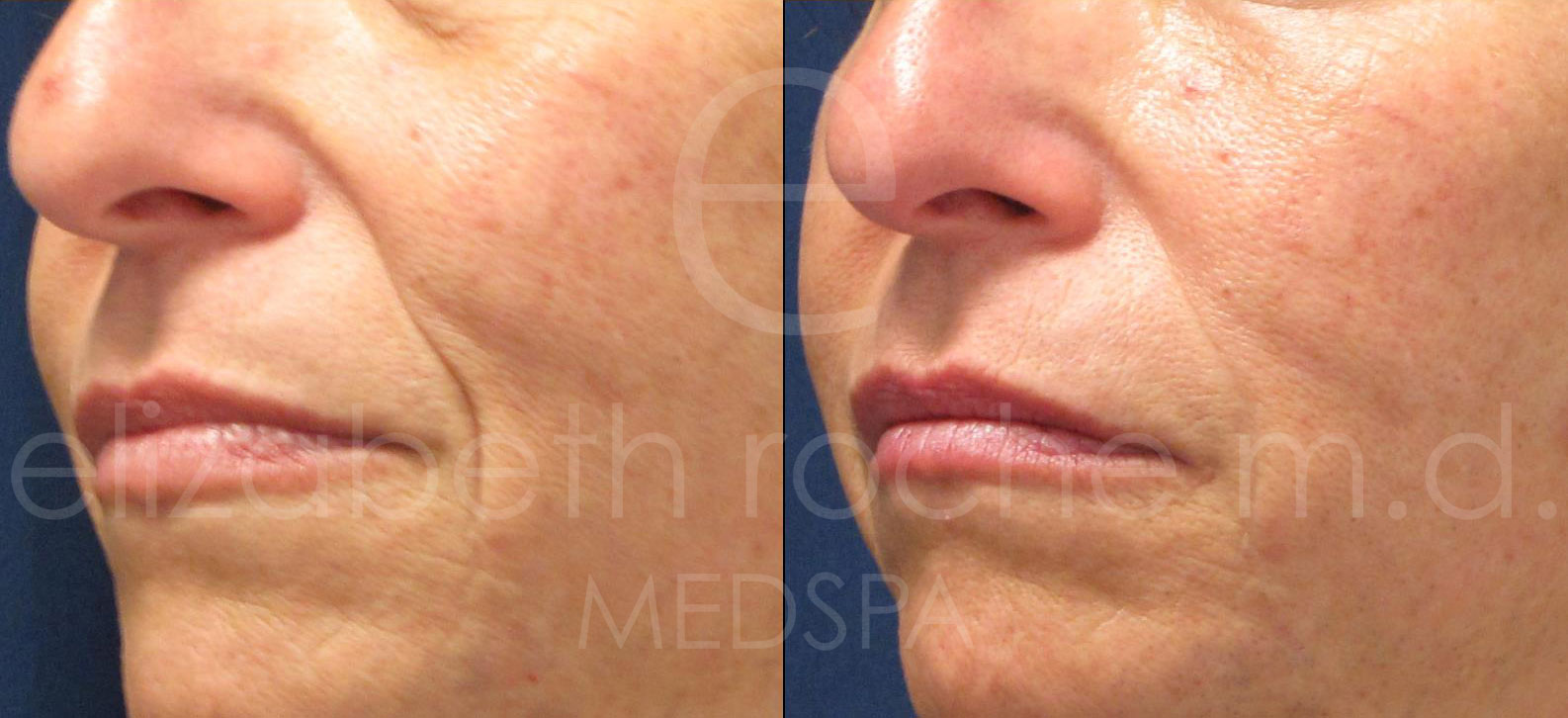 dermal-fillers-under-eyes_nasal-labial-folds_marionette-lines-cropped-wm