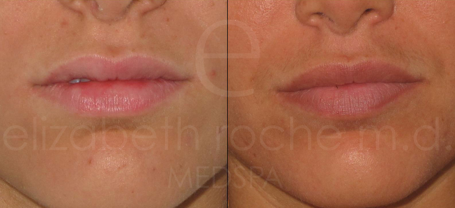 lips1-wm