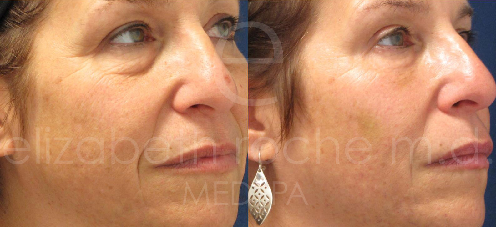 undereyes-wm