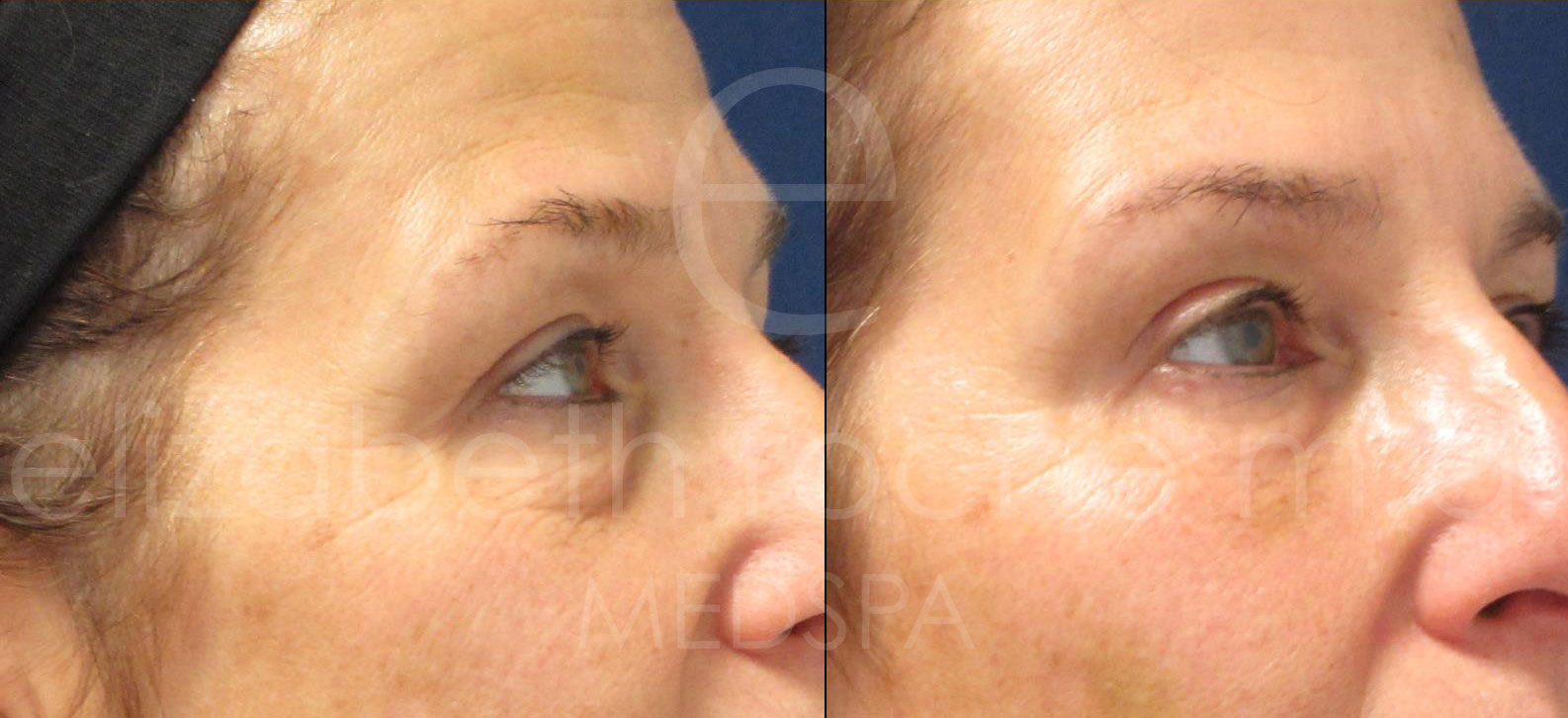 undereyes2-wm