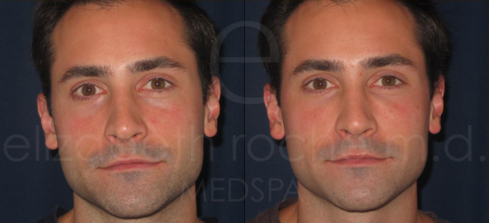 undereyes3-wm