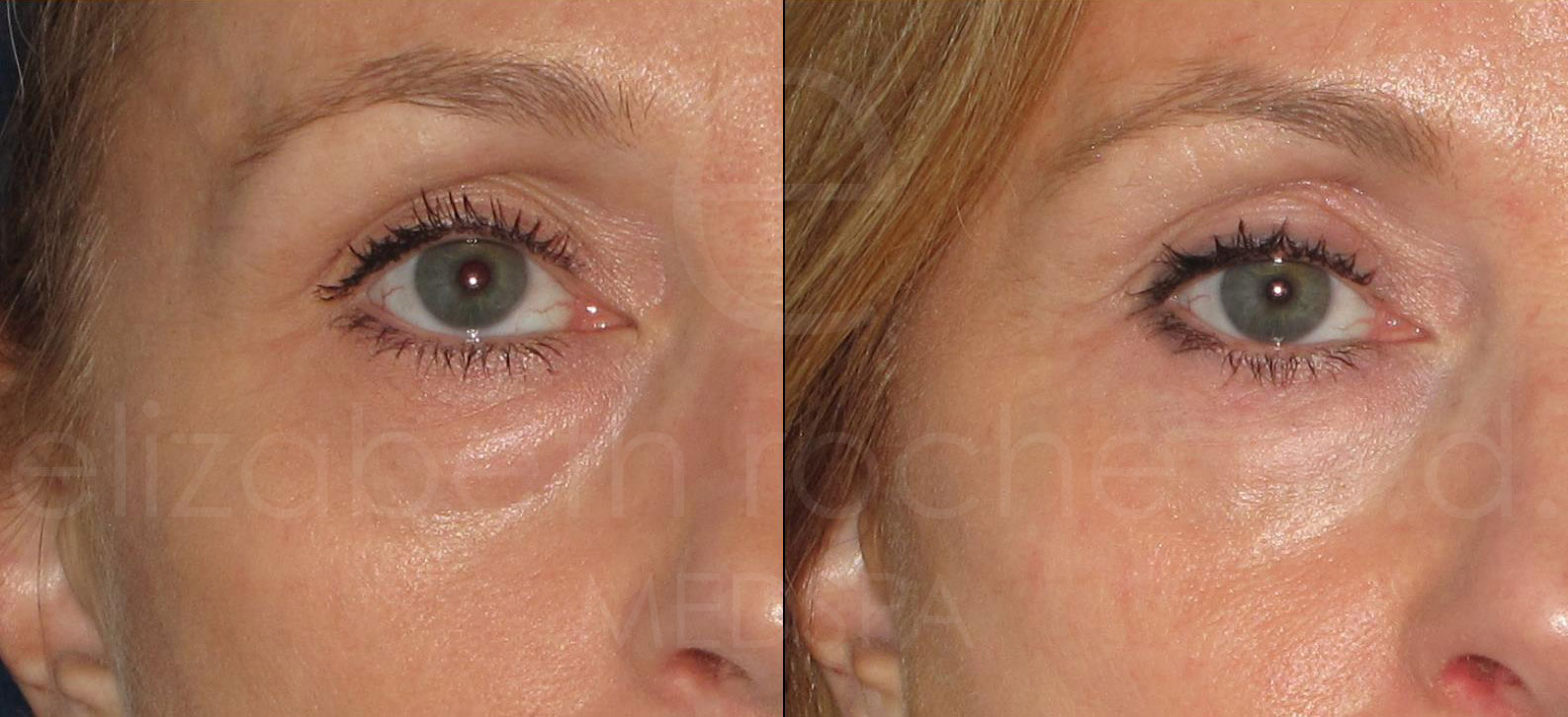 undereyes4-wm