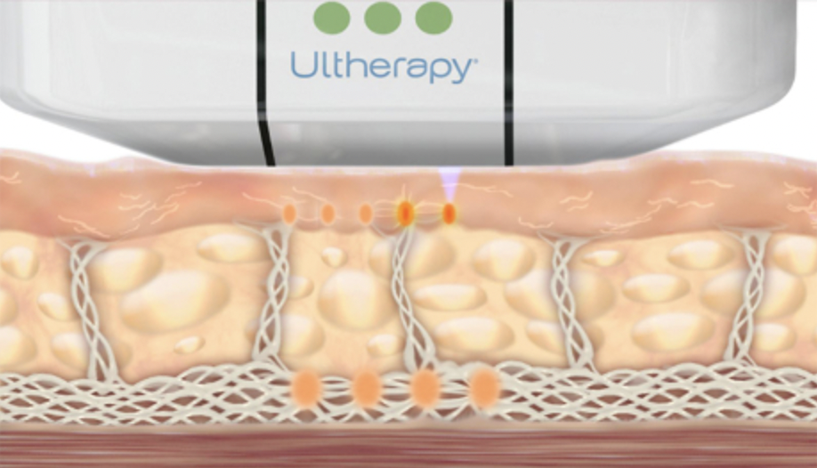 Ultherapy